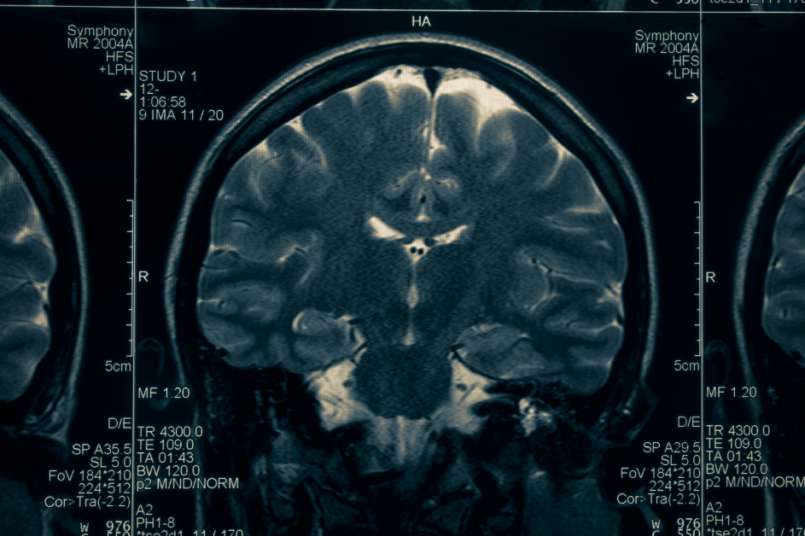 MECCANISMI D’AZIONE E CORRELATI NEUROBIOLOGICI DEL TRAINING AUTOGENO